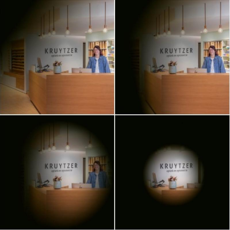 Alles wat je moet weten over Glaucoom 👁️